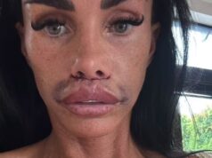 GOSSIP99 : Katie Price shows off her swollen face in new update after undergoing lip filler corrective surgery