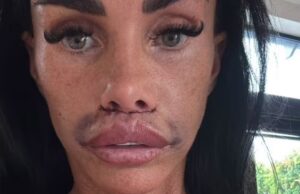 GOSSIP99 : Katie Price shows off her swollen face in new update after undergoing lip filler corrective surgery