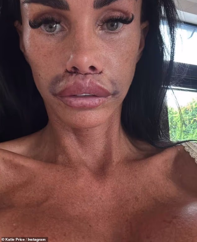 GOSSIP99 : Katie Price shows off her swollen face in