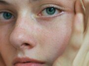GOSSIP99 : Laser Vein Removal Transformed My Face, Here’s Why It Made Such A Difference