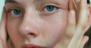 GOSSIP99 : Laser Vein Removal Transformed My Face, Here’s Why It Made Such A Difference