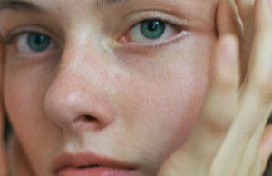 GOSSIP99 : Laser Vein Removal Transformed My Face, Here’s Why It Made Such A Difference
